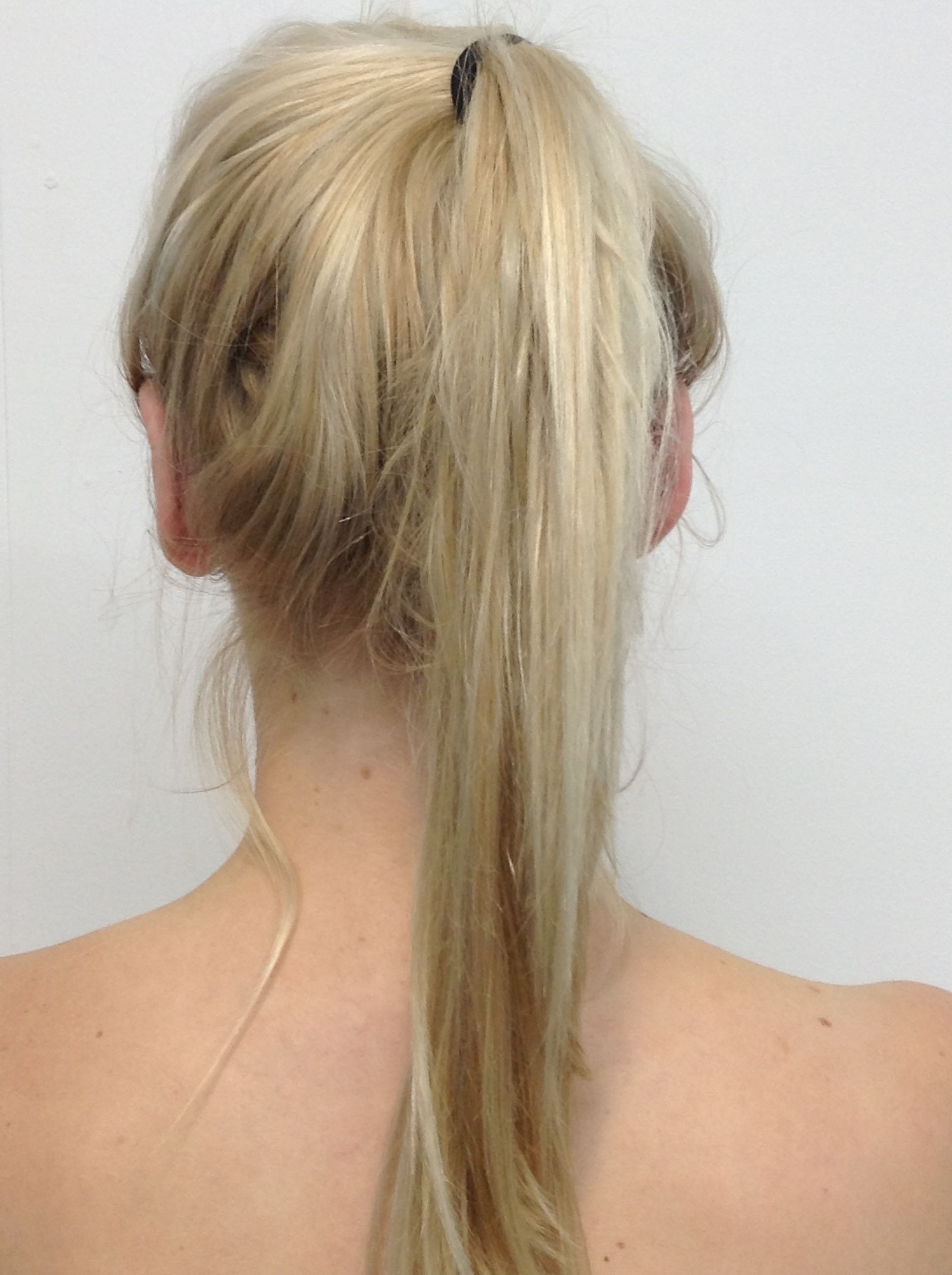 Otoplasty (Ear Pinning) clinical image 14