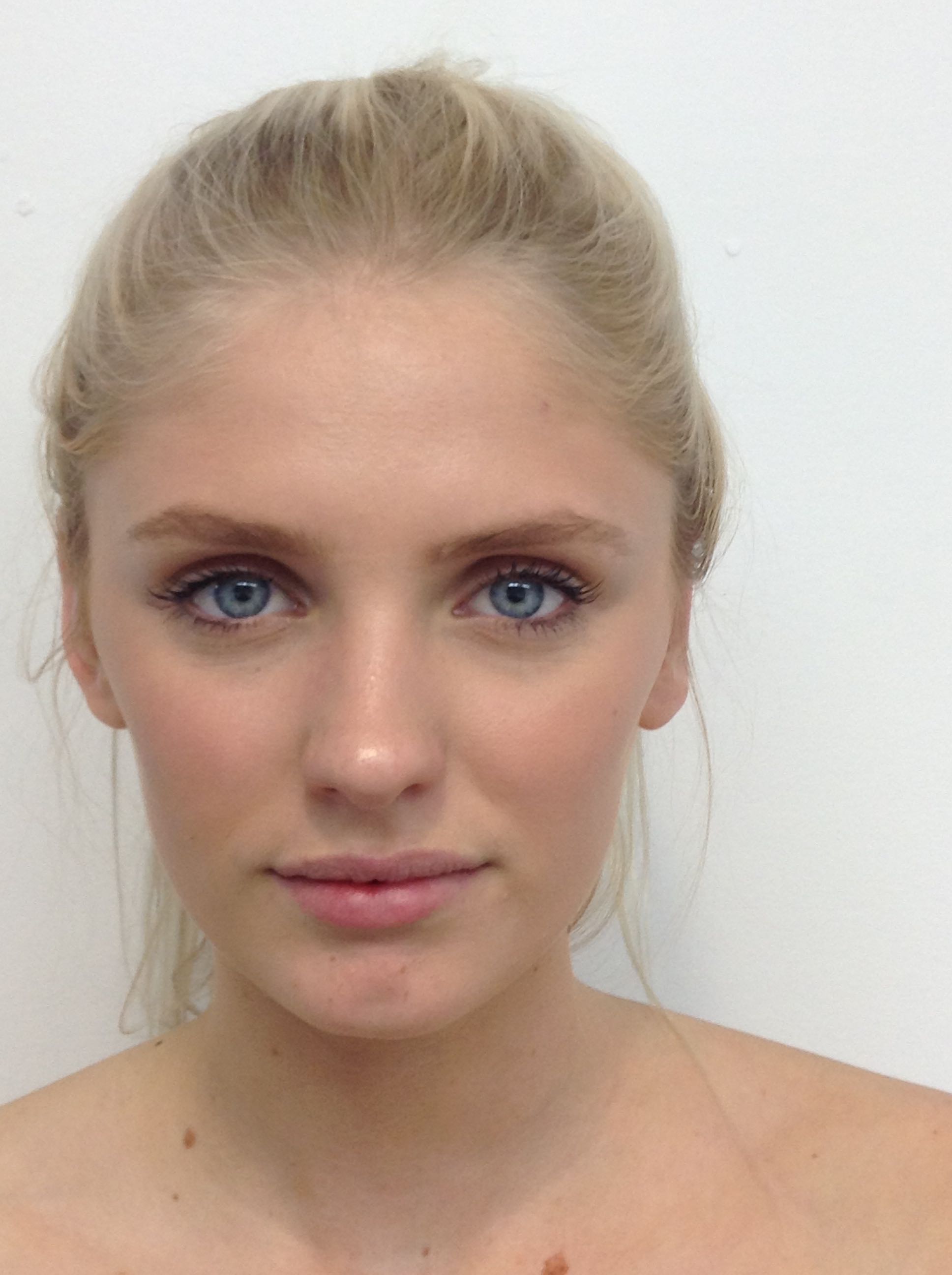 Otoplasty (Ear Pinning) clinical image 15