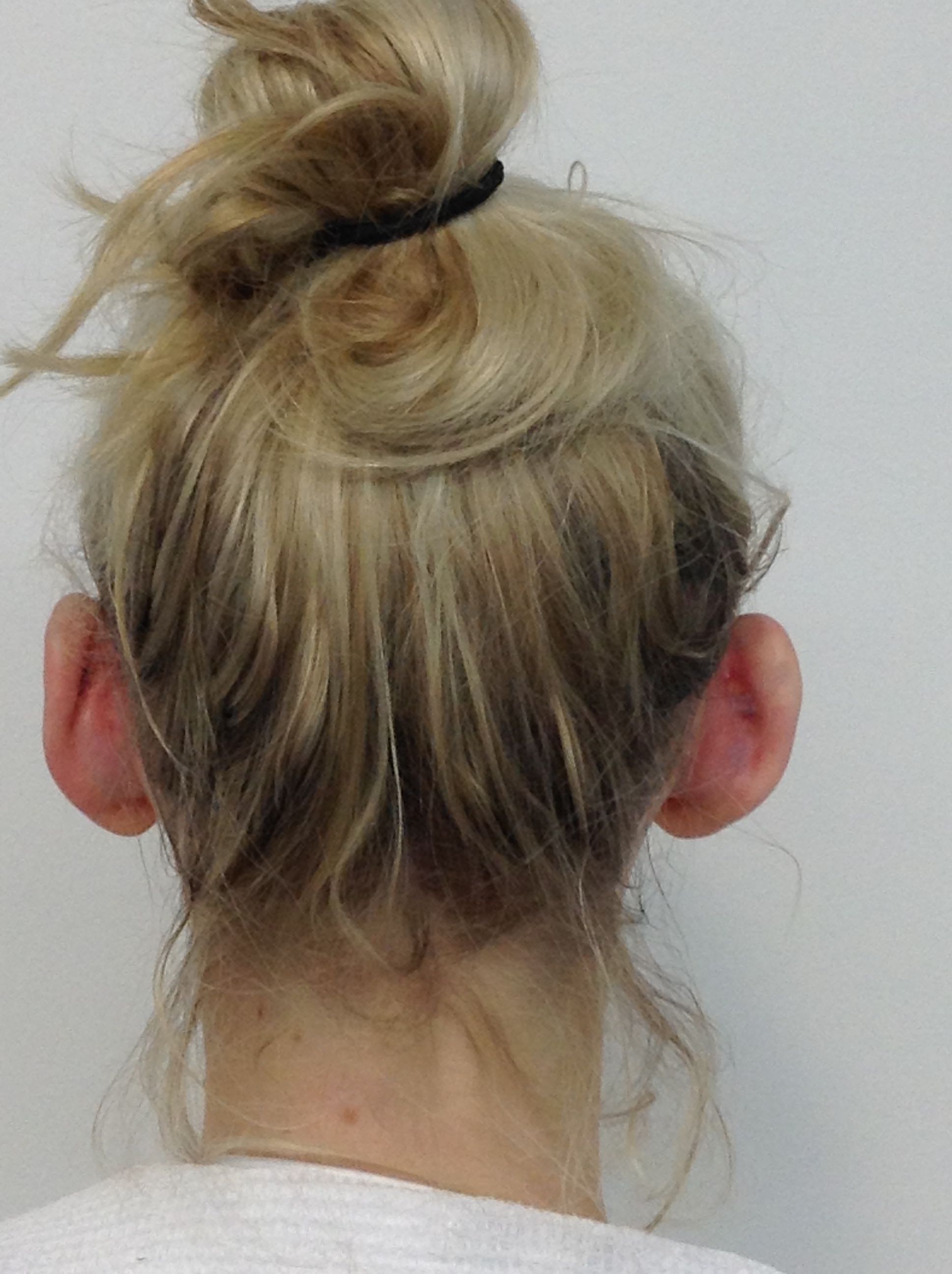 Otoplasty (Ear Pinning) clinical image 16