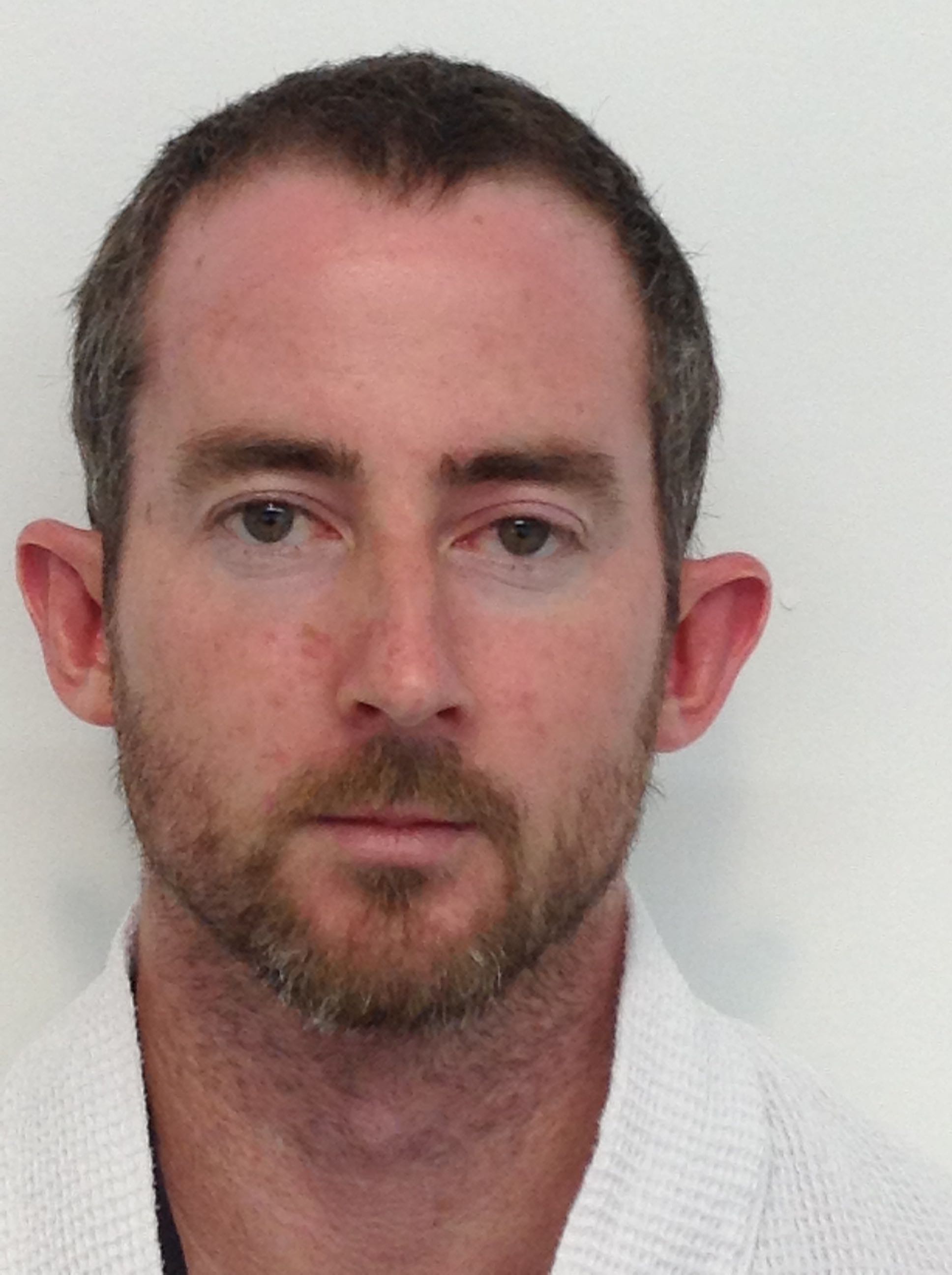 Otoplasty (Ear Pinning) clinical image 17