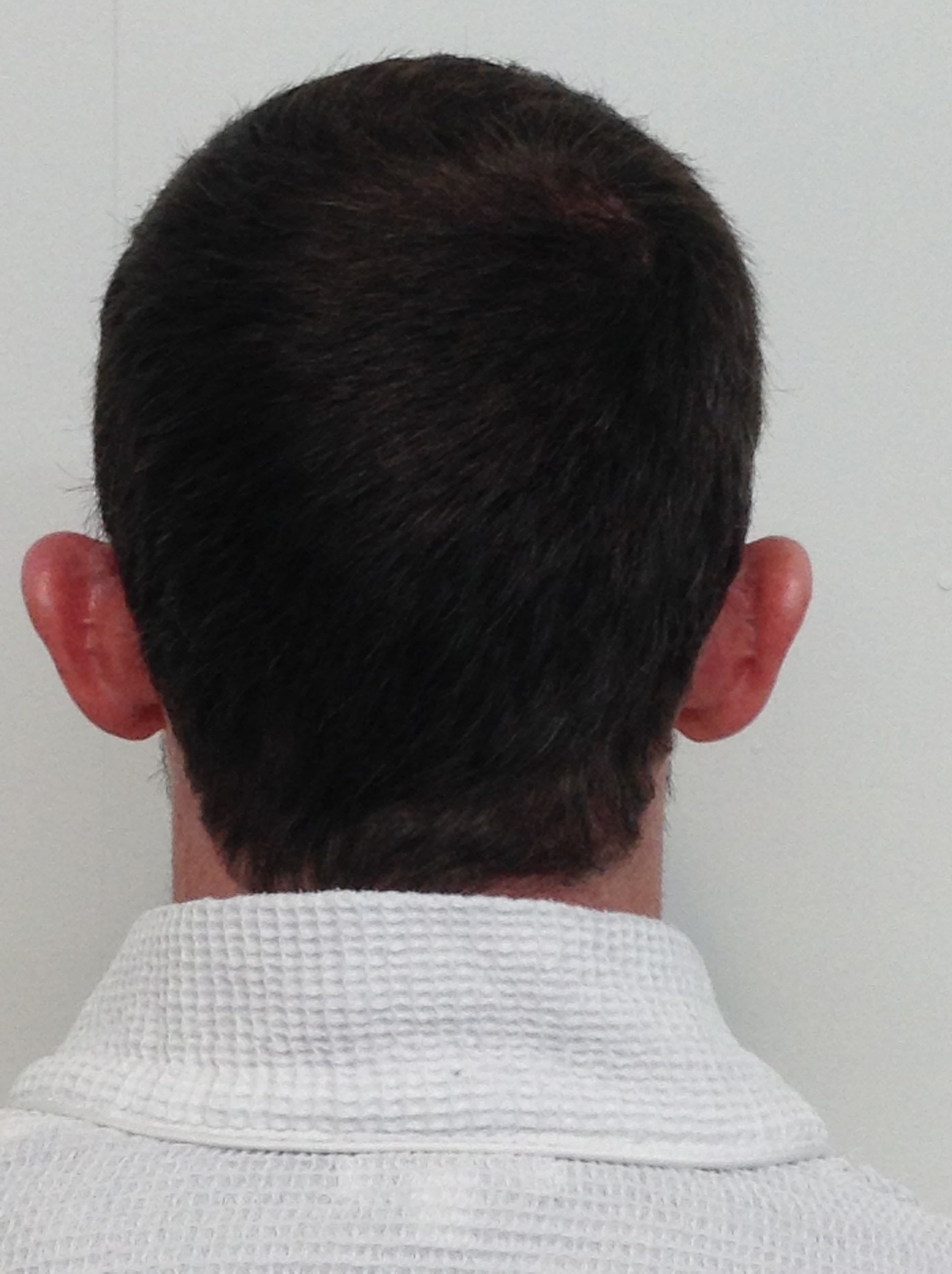 Otoplasty (Ear Pinning) clinical image 18