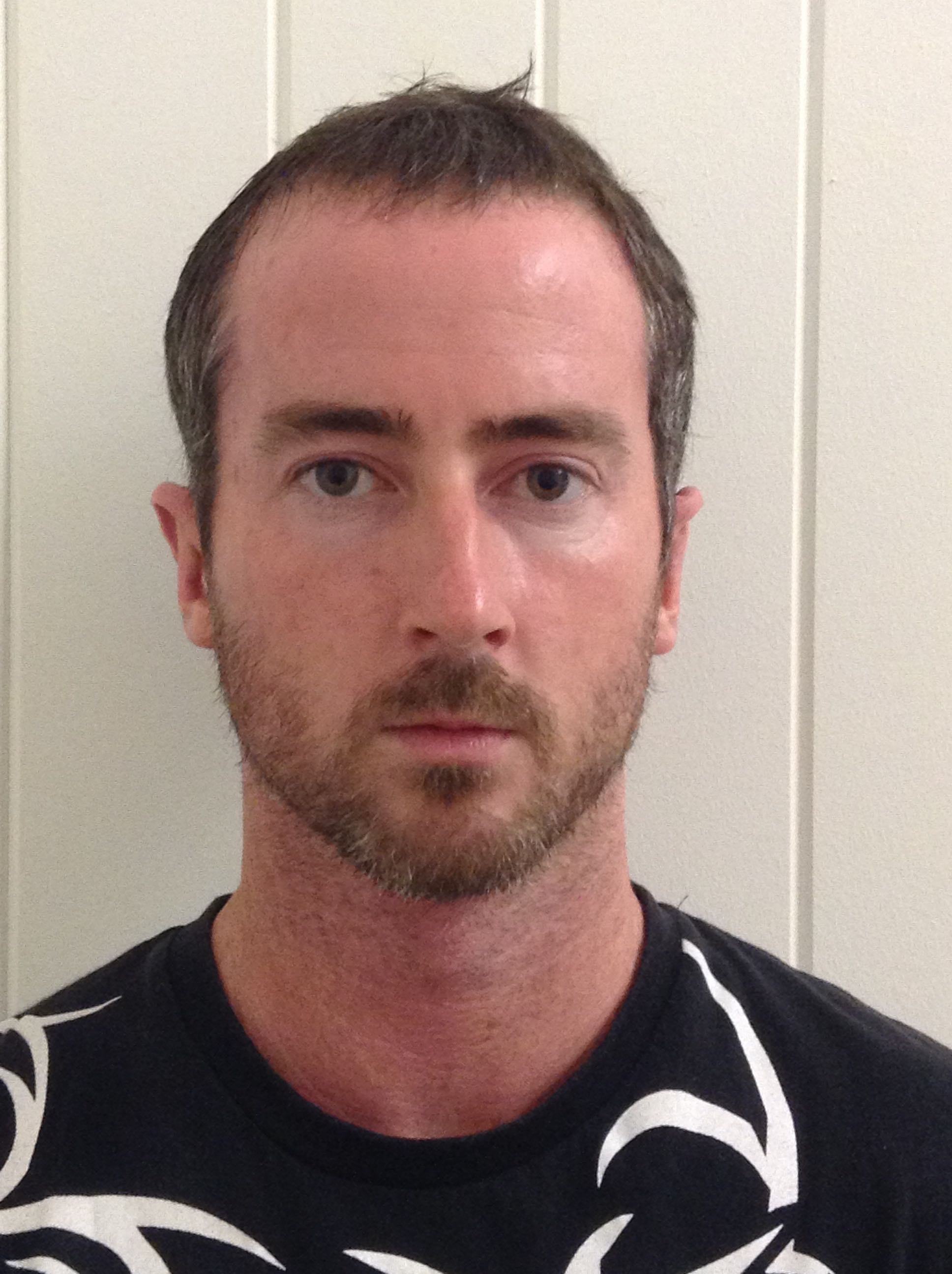 Otoplasty (Ear Pinning) clinical image 19