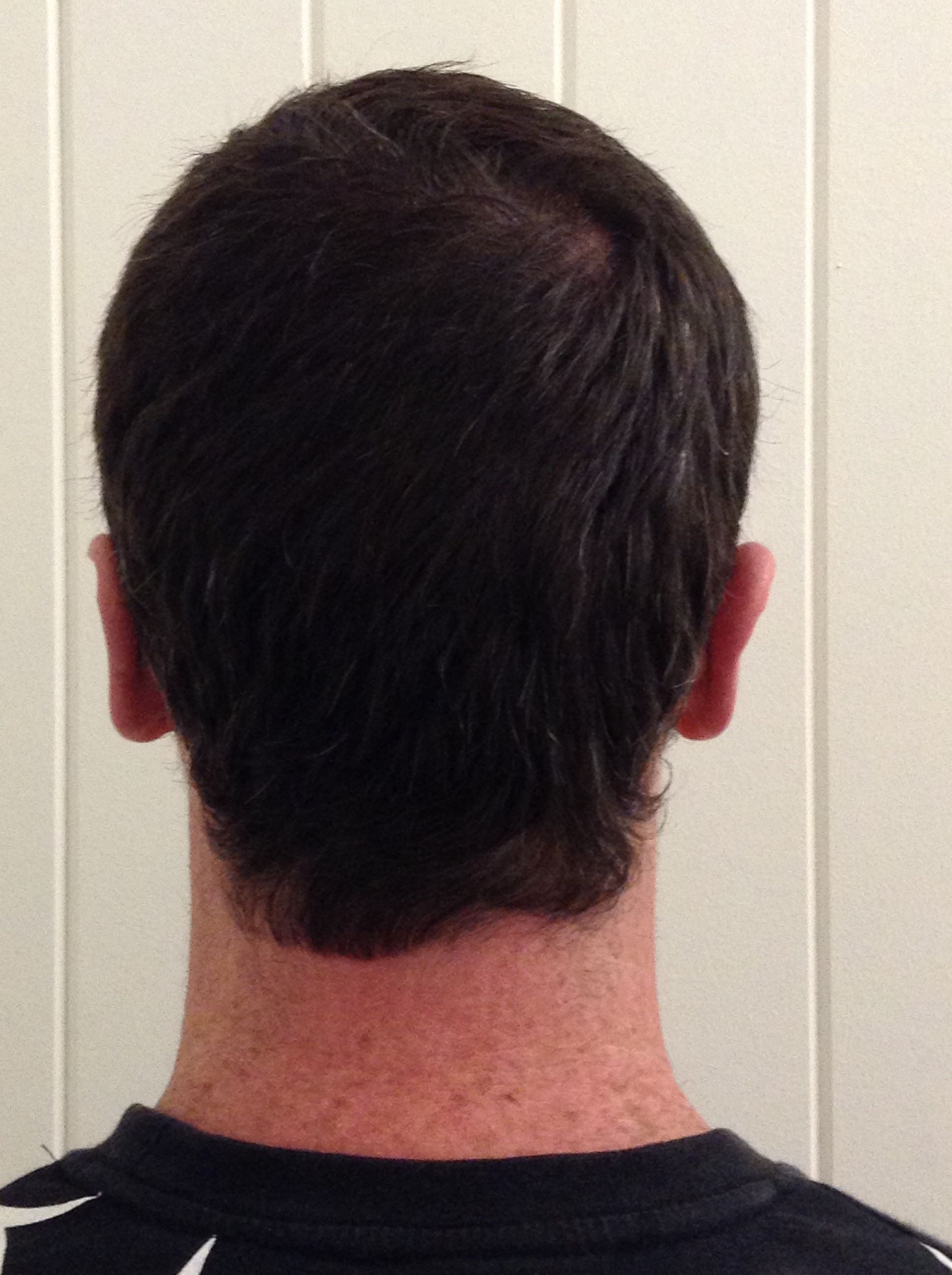 Otoplasty (Ear Pinning) clinical image 20