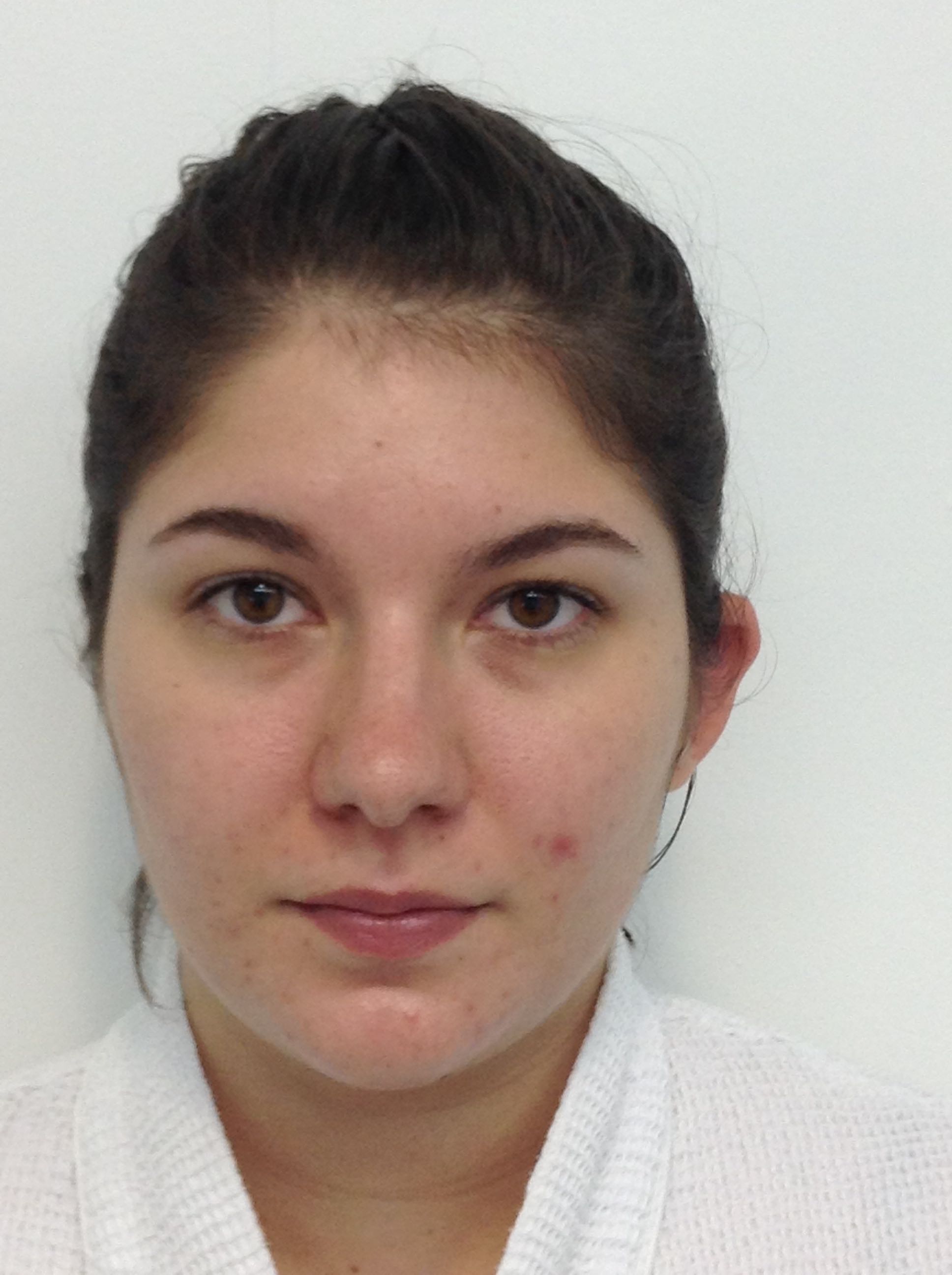 Otoplasty (Ear Pinning) clinical image 21