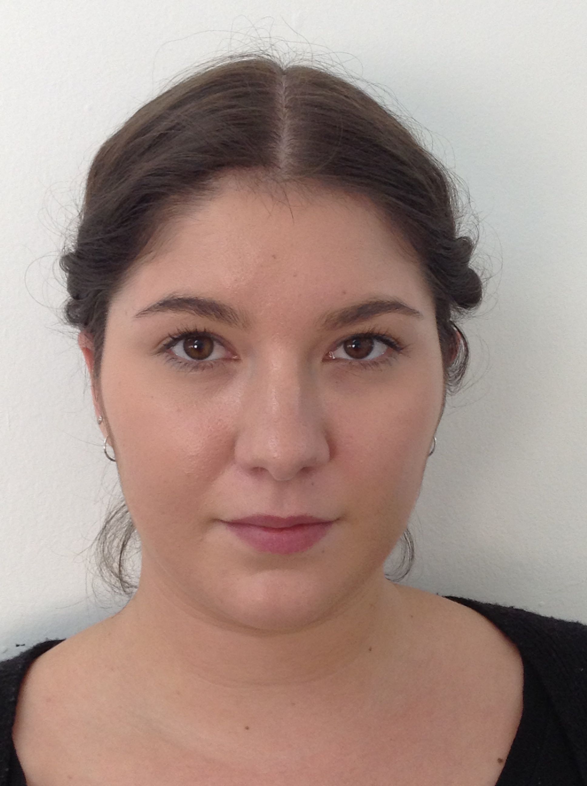 Otoplasty (Ear Pinning) clinical image 23