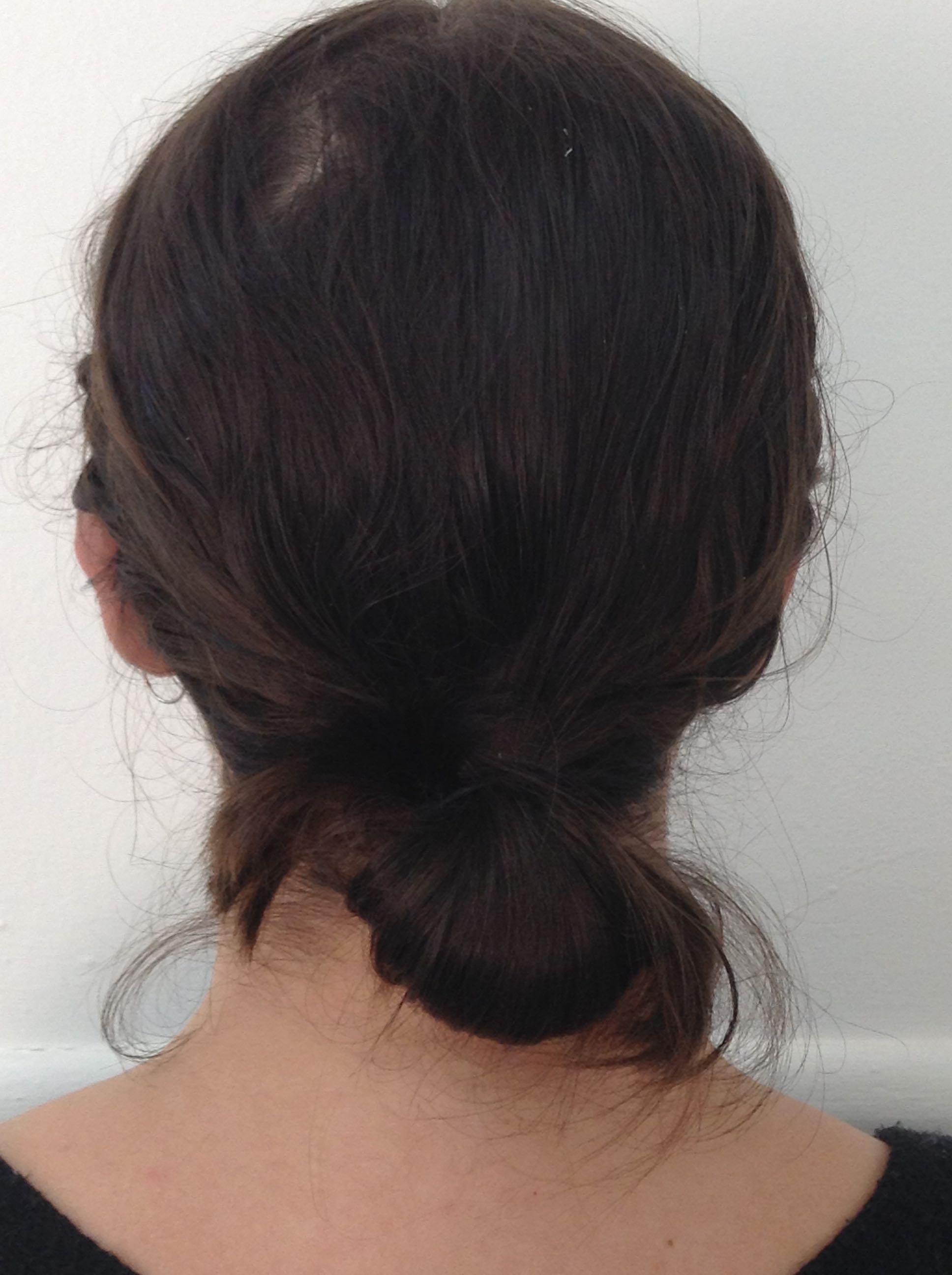 Otoplasty (Ear Pinning) clinical image 24