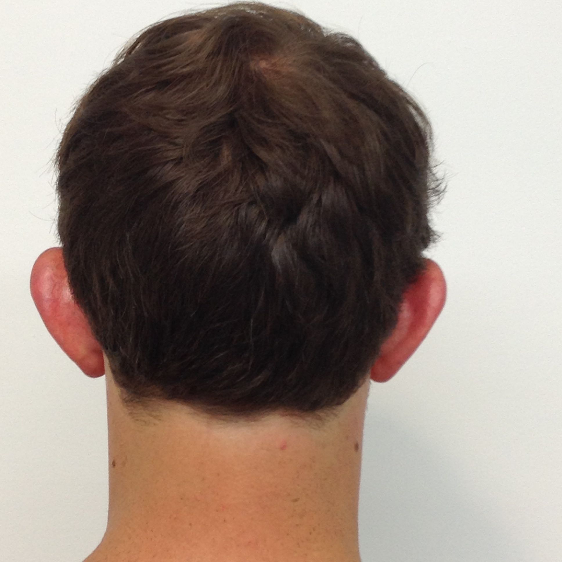 Otoplasty (Ear Pinning) clinical image 26