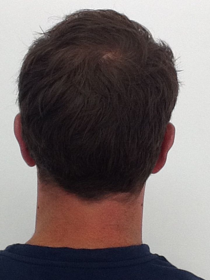 Otoplasty (Ear Pinning) clinical image 28