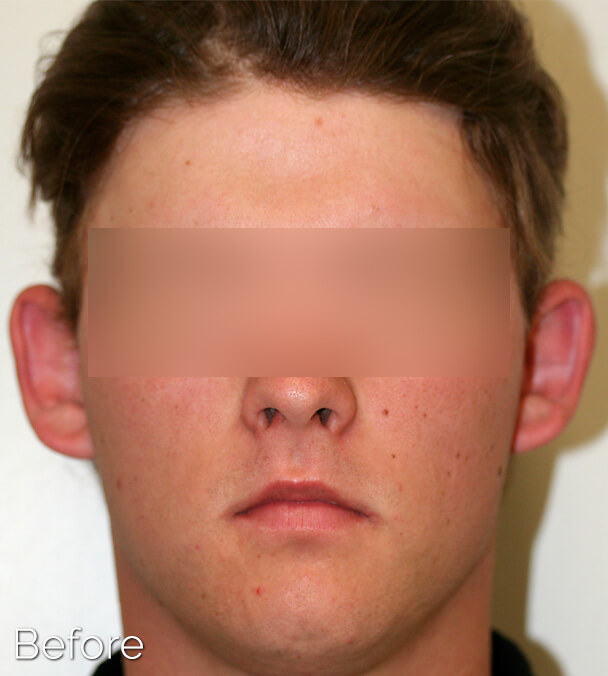 Otoplasty (Ear Pinning) clinical image 29