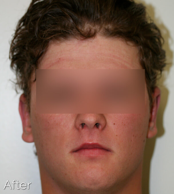 Otoplasty (Ear Pinning) clinical image 30