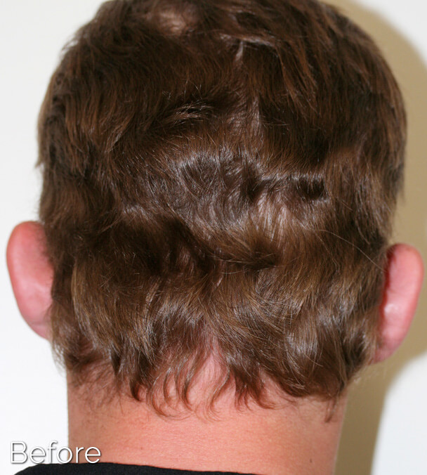 Otoplasty (Ear Pinning) clinical image 31