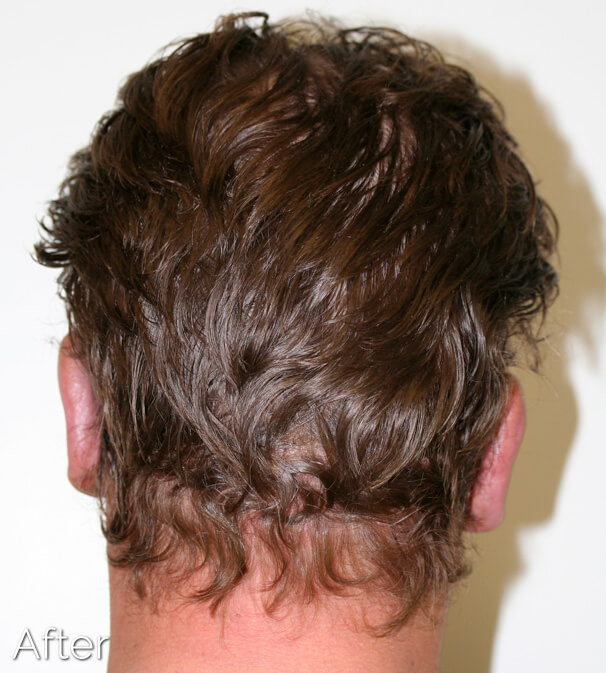 Otoplasty (Ear Pinning) clinical image 32